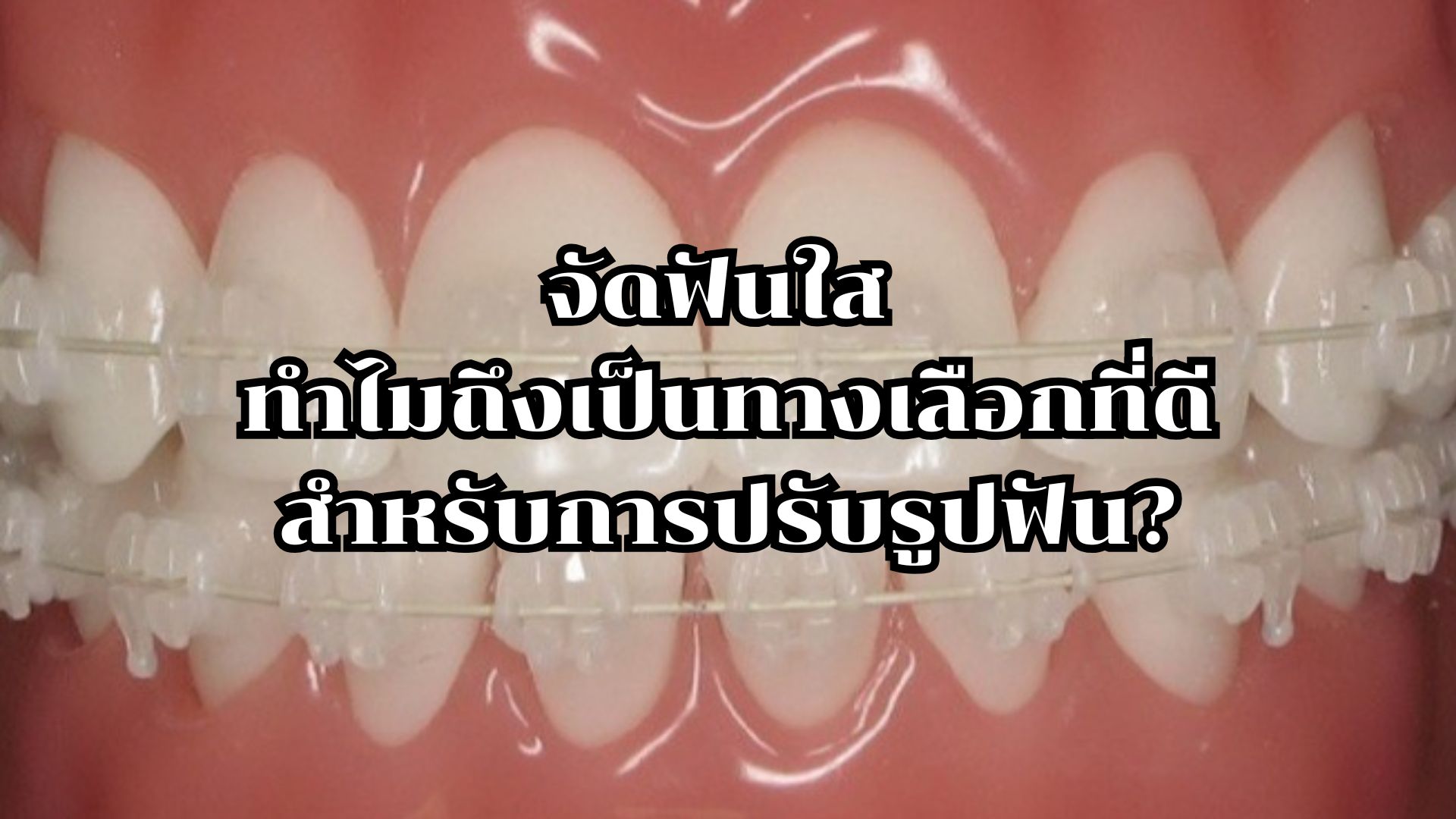 จัดฟันใส